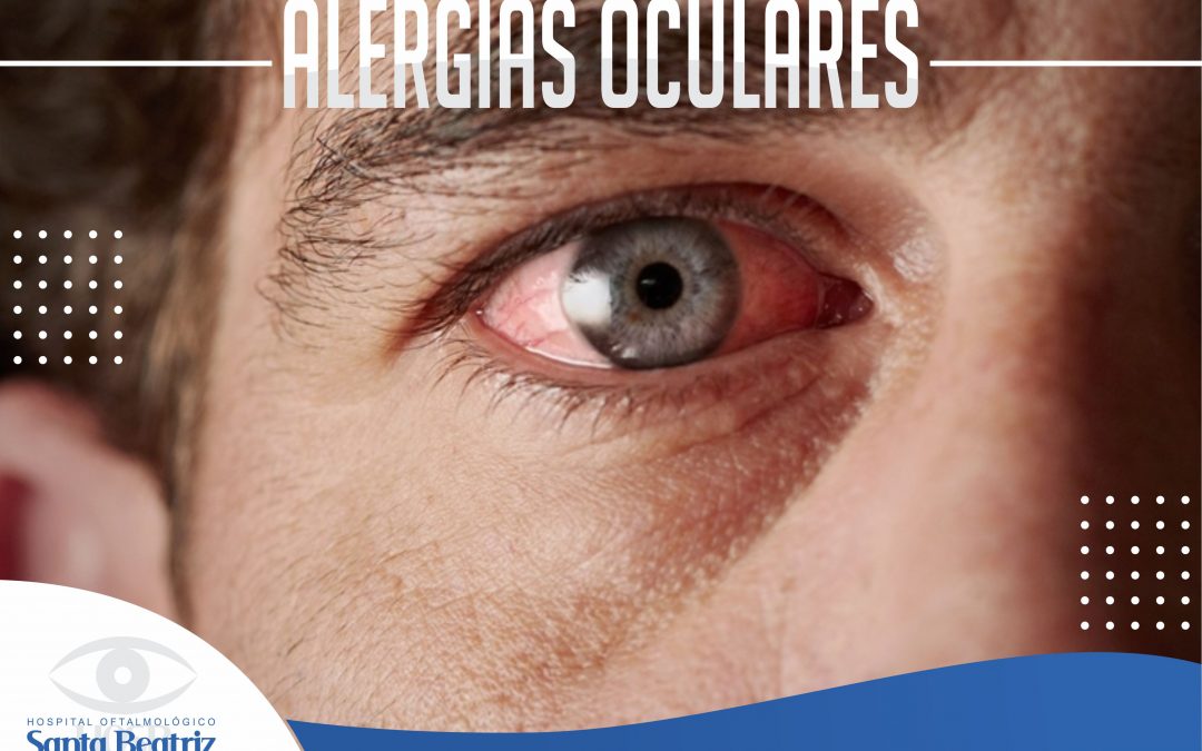 Alergias oculares
