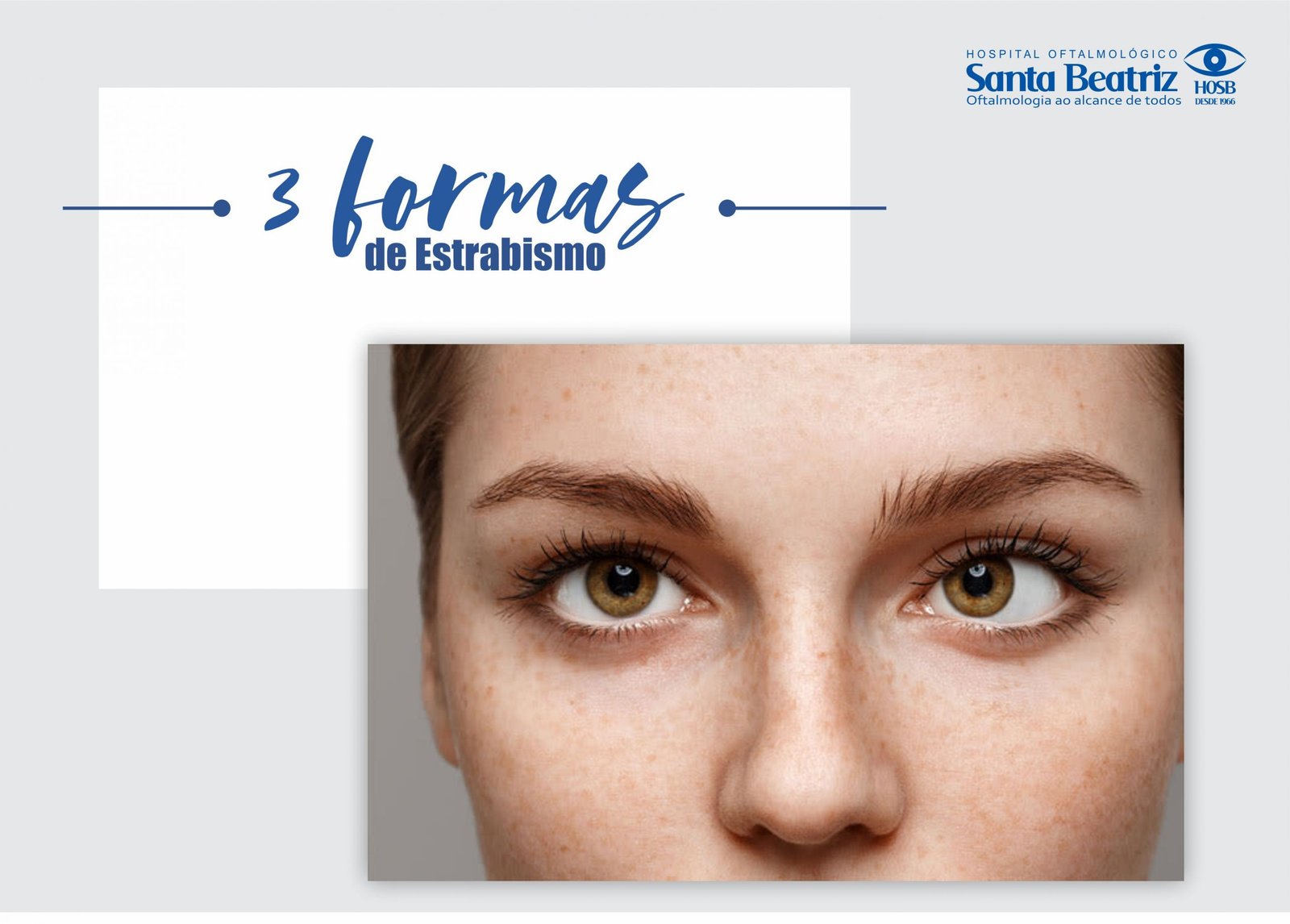 3 formas de estrabismo - HOSB